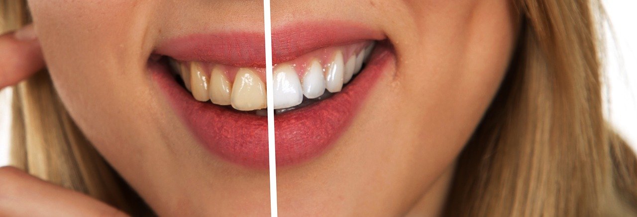 Cách làm trắng răng tại nhà đơn giản nhất cho bạn