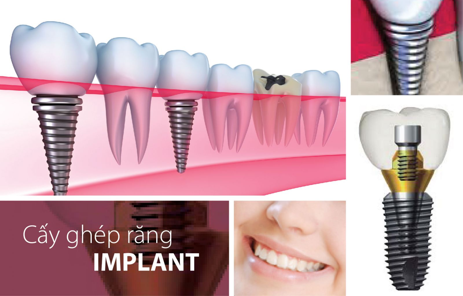 trồng răng hàm implant